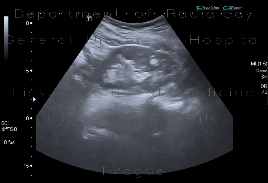 Angiomyolipoma of kidney, renal angiomyolipoma