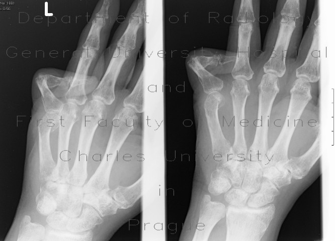 Ankylosis in Dupytren contracture
