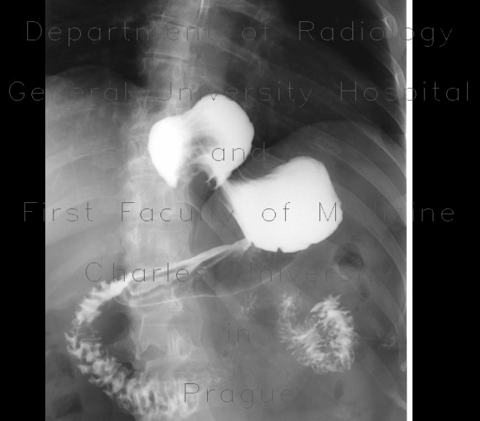 Antireflux plastic, fundoplication, Nissen, slipped above the diaphraghm