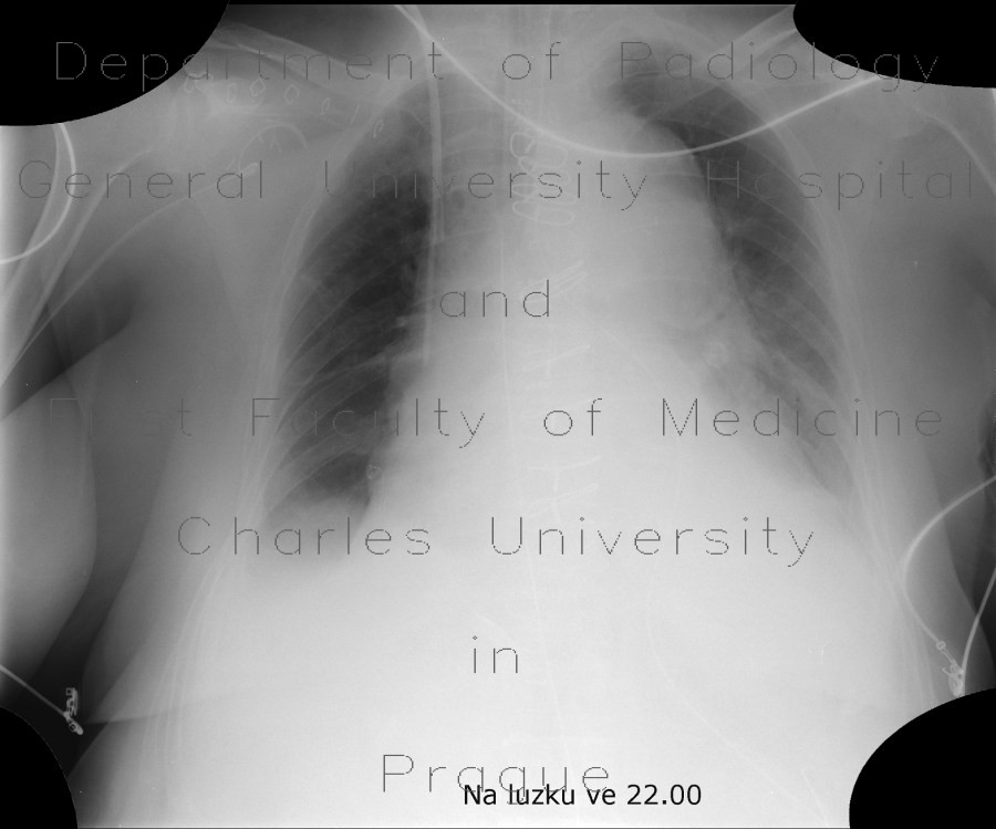 Aortic dissection, Stanford A, hemopericard