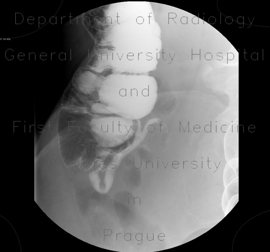 Appendicography, appendicolith, fecal stone