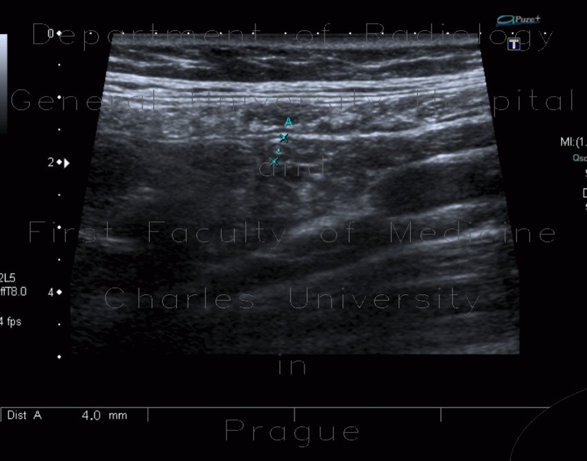 Appendix, normal appearance
