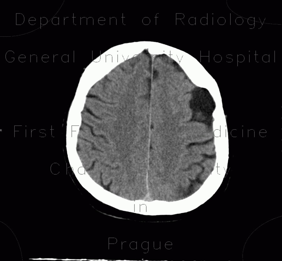 Arachnoid cyst, frontal lobe