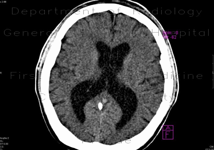 Arrested hydrocephalus