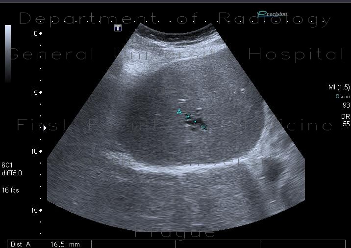 Arteriovenous malformation of liver, AV malformation