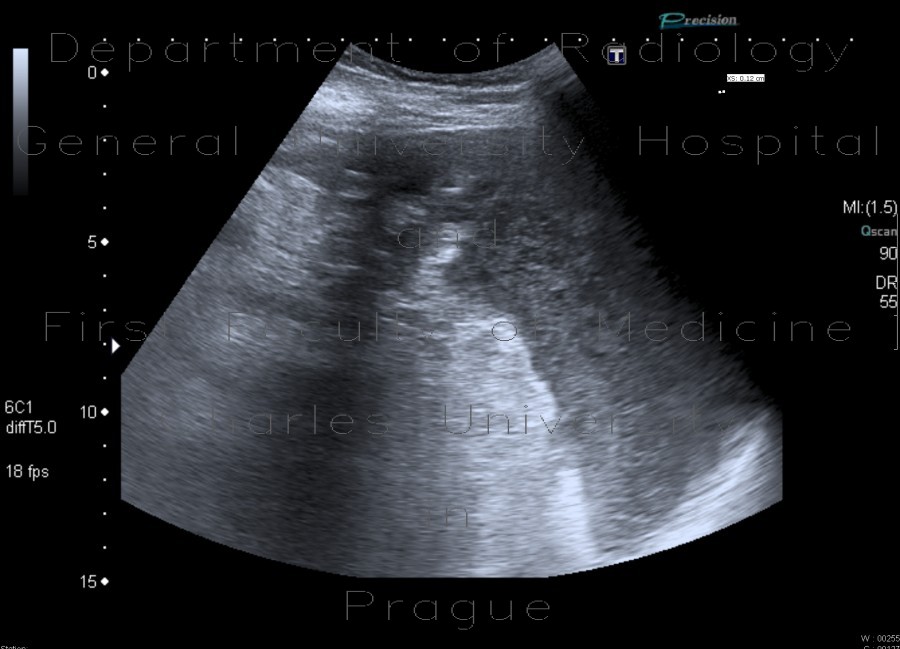 Ascites, echogenic ascites, perofration of stomach ulcer