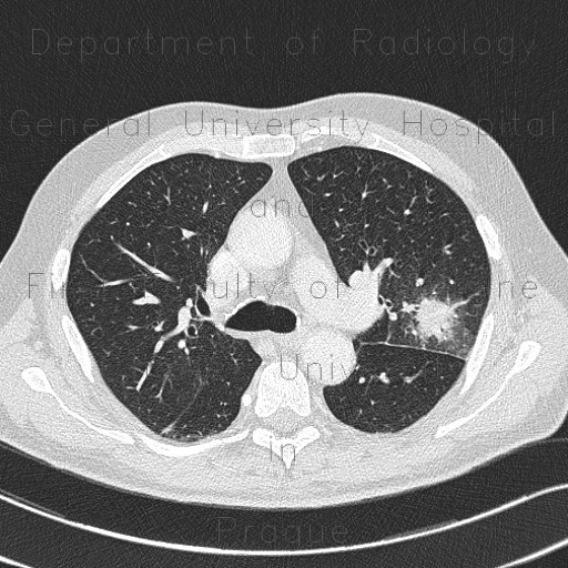 Aspergilloma, aspergillosis, angio-invasive aspergillosis, doubling time, initial scan