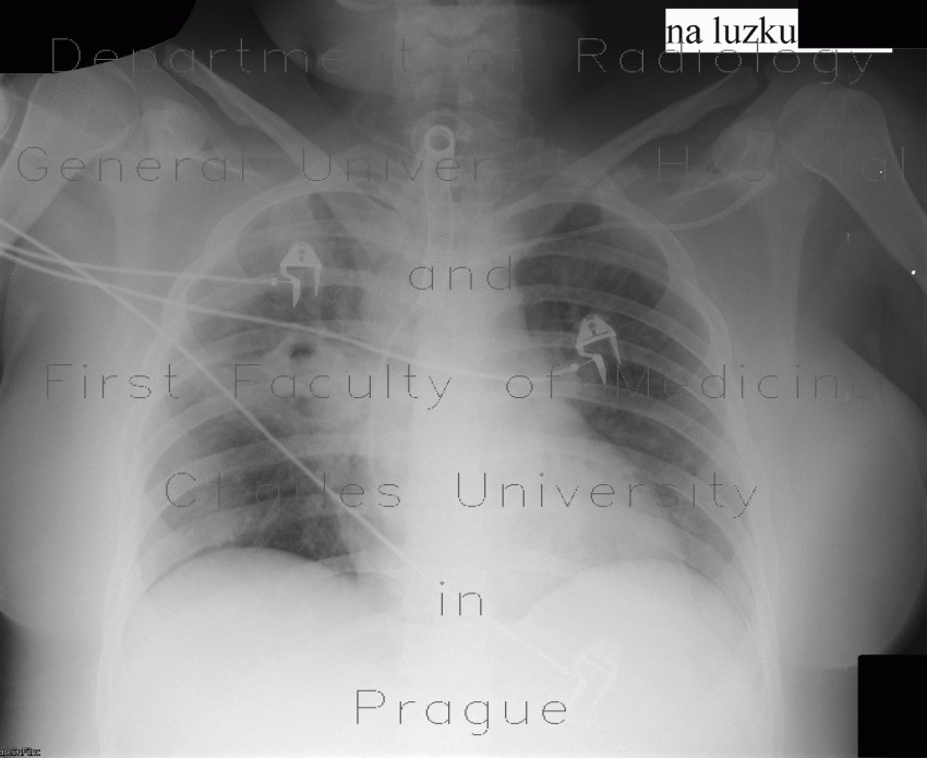Aspergilosis of the lung