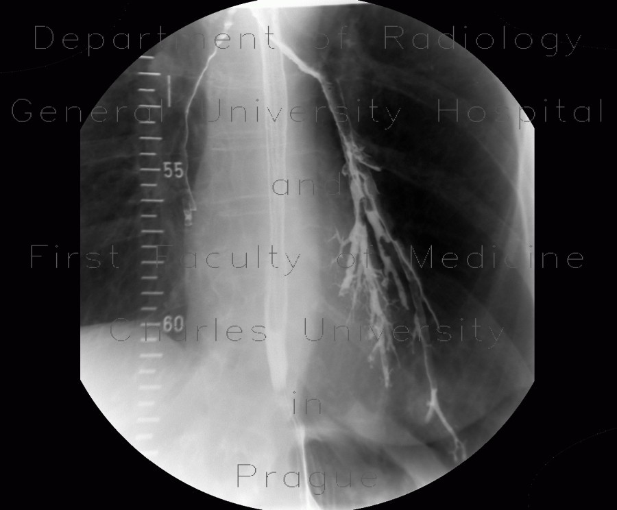 Aspiration of contrast, dysphagia