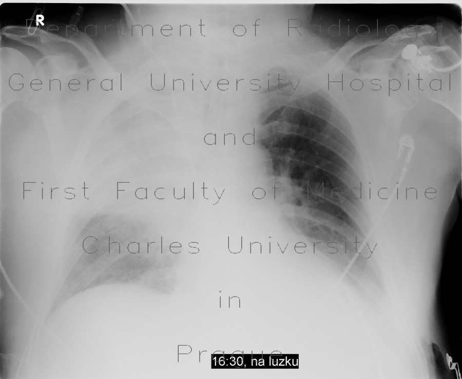 Aspiration pneumonia