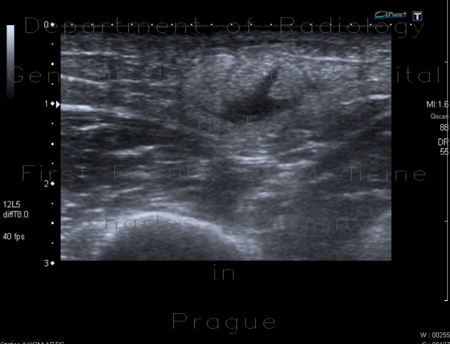 Atheroma, arm