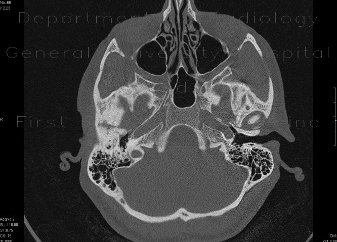 Atresia of external auditory canal