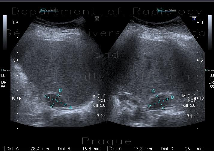 Atypical hemangioma