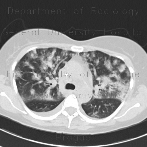 Atypical pneumonia