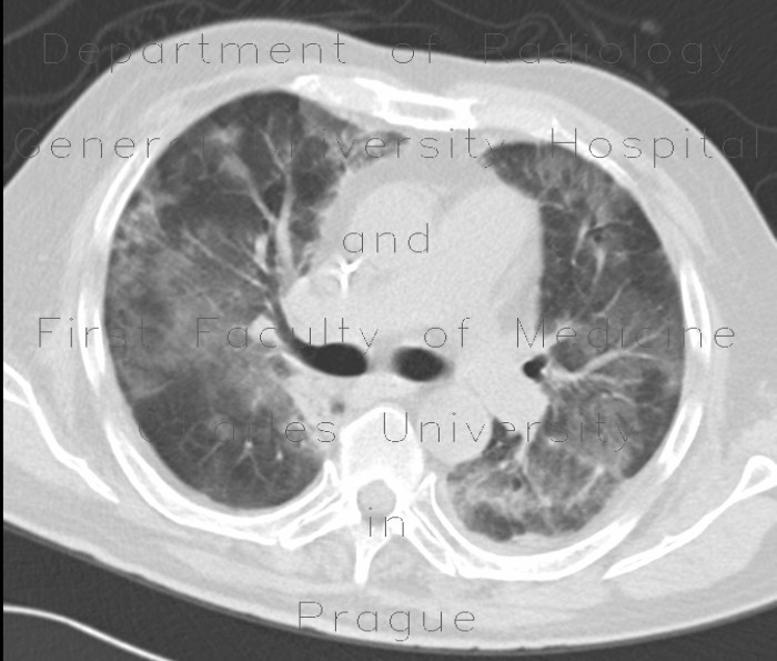 Atypical pneumonia