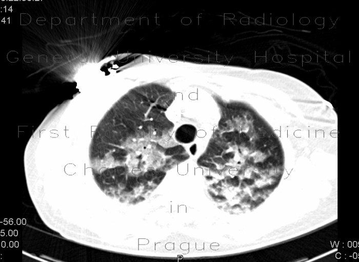 Atypical pneumonia