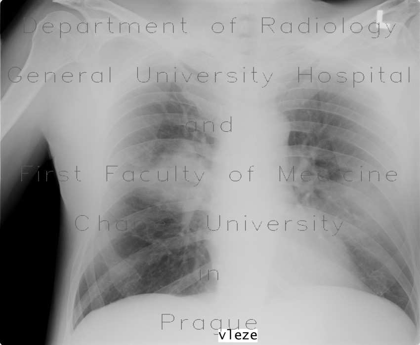 Atypical pneumonia
