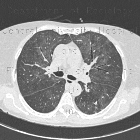 Atypical pneumonia, CMV