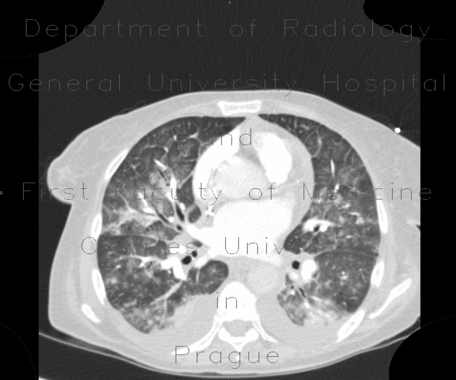 Atypical pneumonia, Pneumocystis pneumonia, PCP