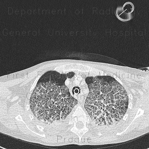 Atypical pneumonia, crazy-paving pattern