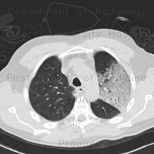 Atypical pneumonia, influenza, H1N1