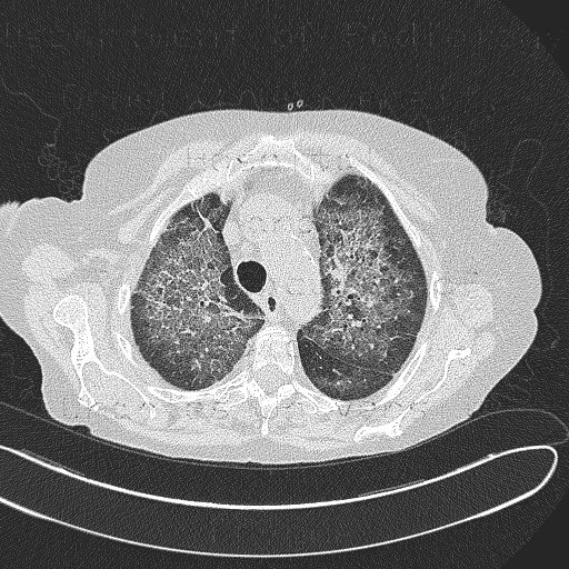 Atypical pneumonia, pneumocystis carini, HRCT