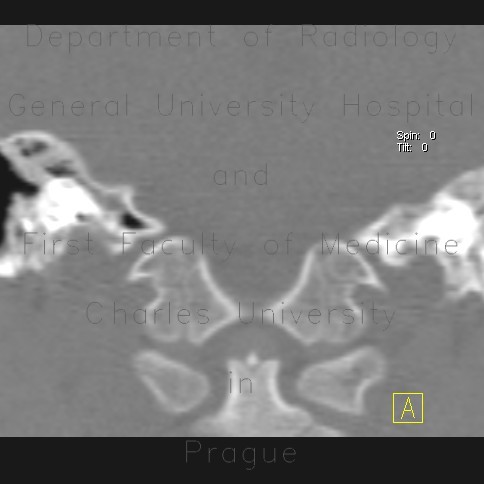Axis, C2, development of vertebra