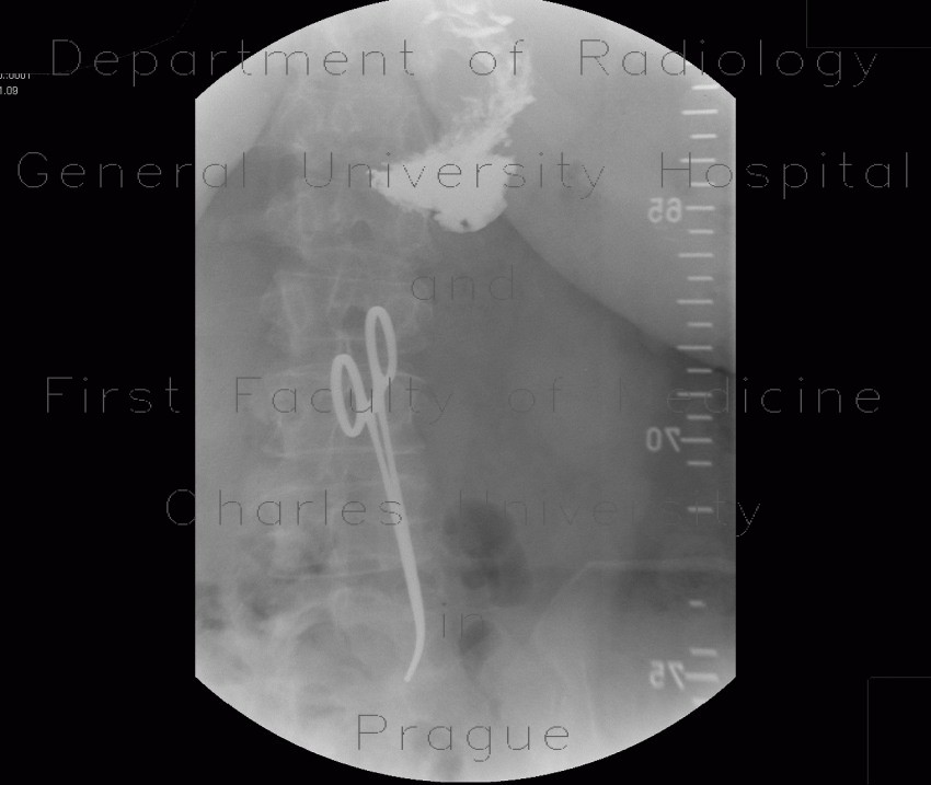 Bariatric surgery, pean