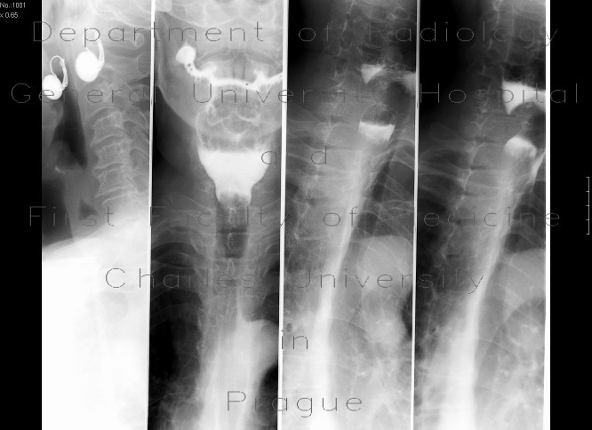 Bezoar of oesophagus