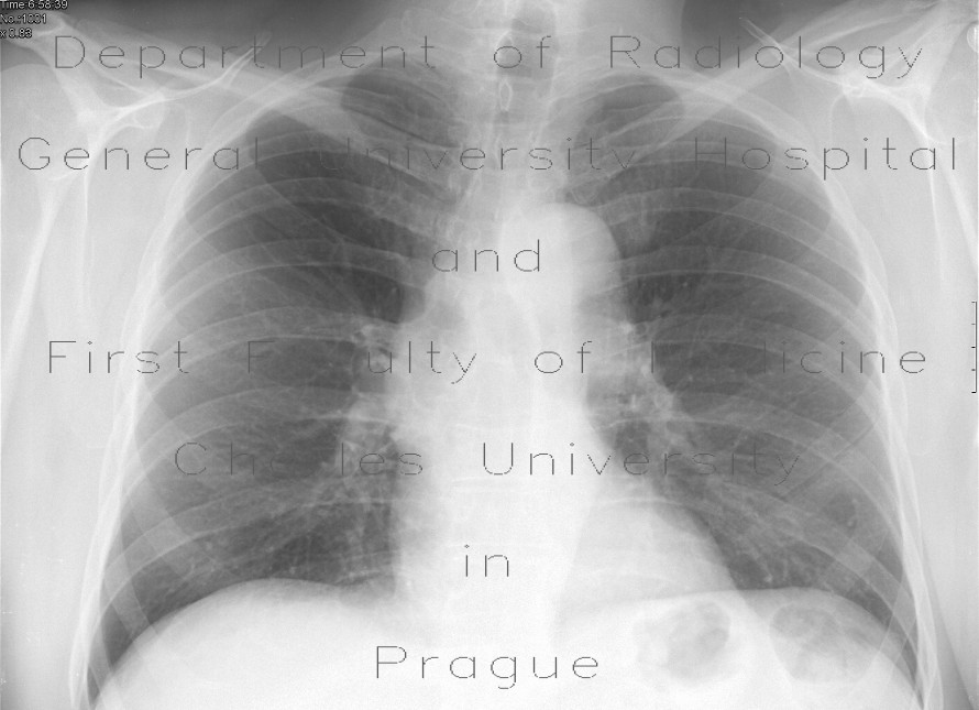 Bifid, forked rib