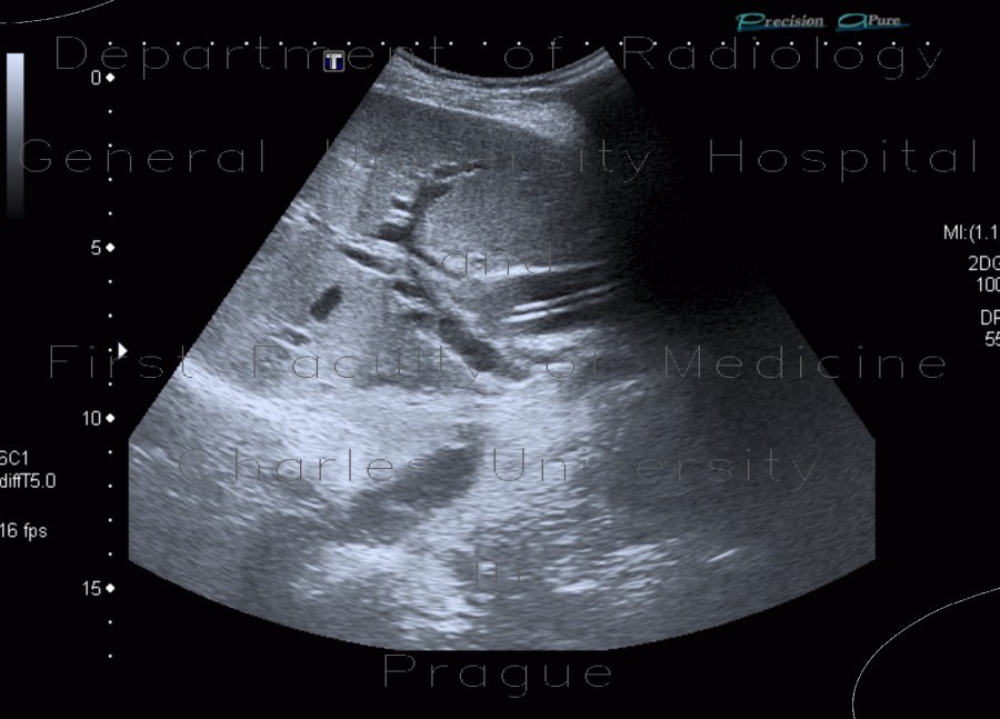 Biliary stent, obstruction