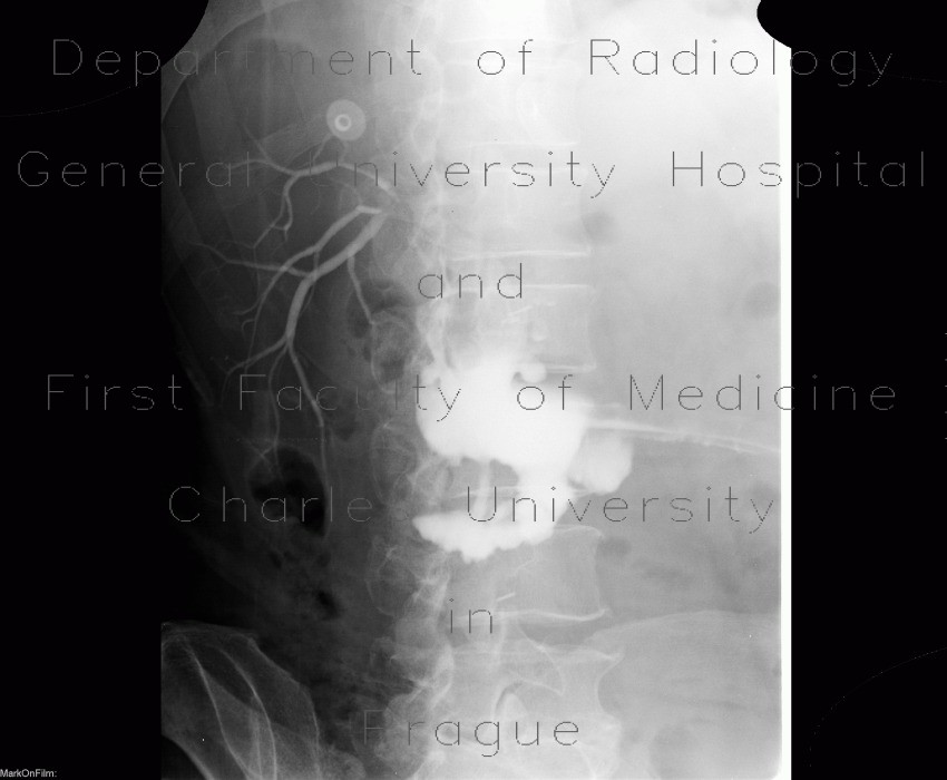Biloma, leak from biliodigestive anastomosis