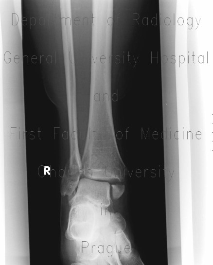 Bimalleolar ankle fracture