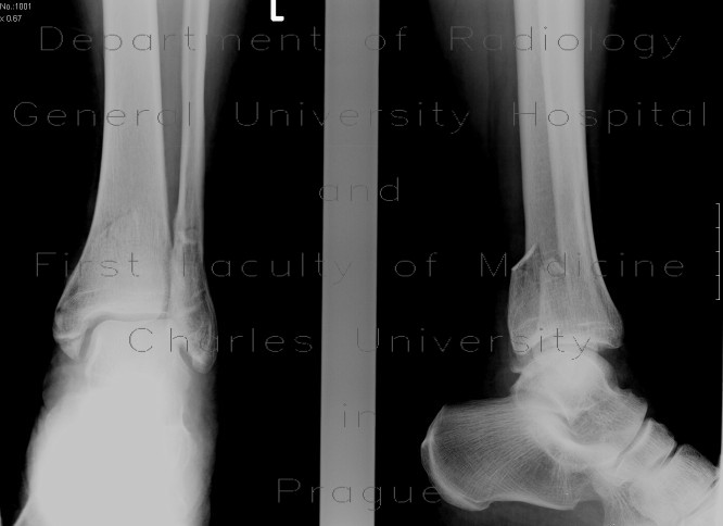 Bimalleolar ankle fracture with abruption of the posterior edge of tibia