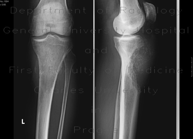 Bladder carcinoma, bone metastasis
