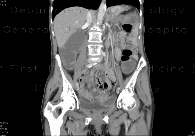 Blind stenosis of sigmoid colon, ileus