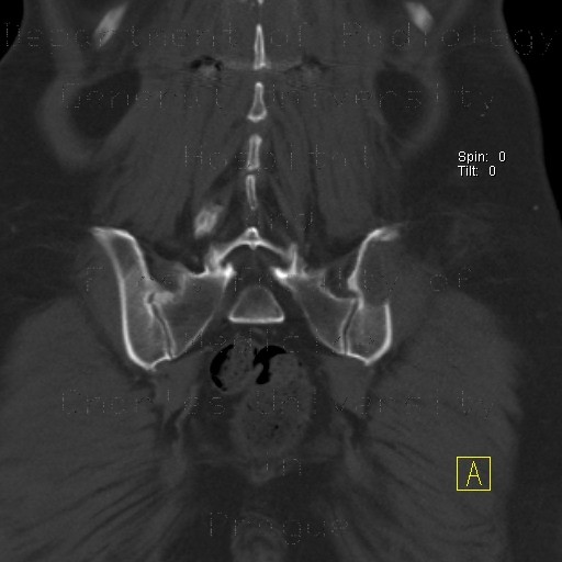 Bone defect after bone graft harvest