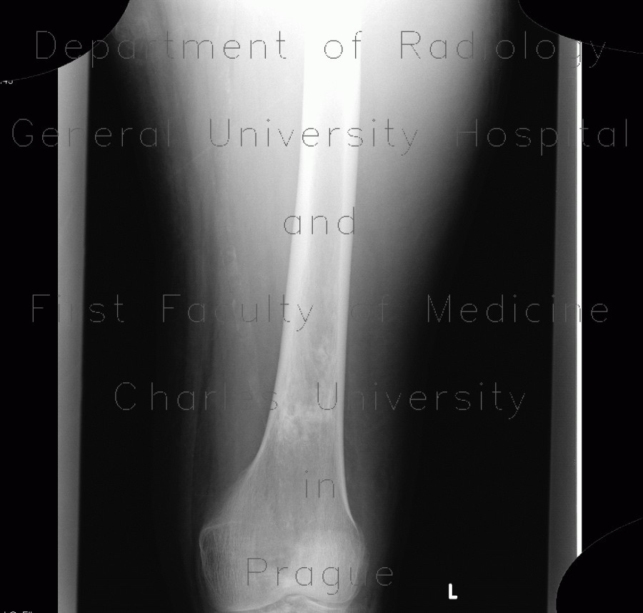 Bone infarction, atherosclerosis