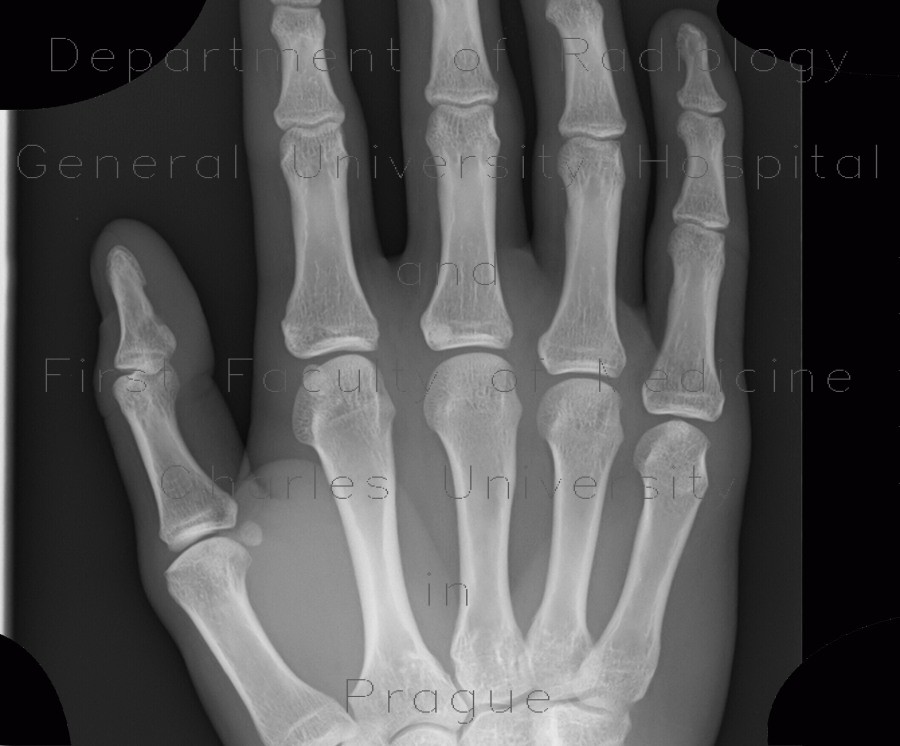 Bone island, metacarpal bone
