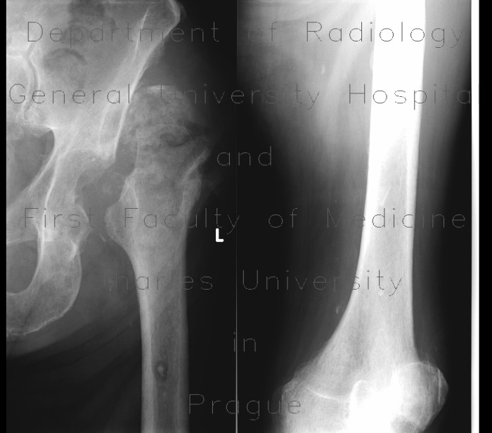 Bone sequestration, osteomyelitis