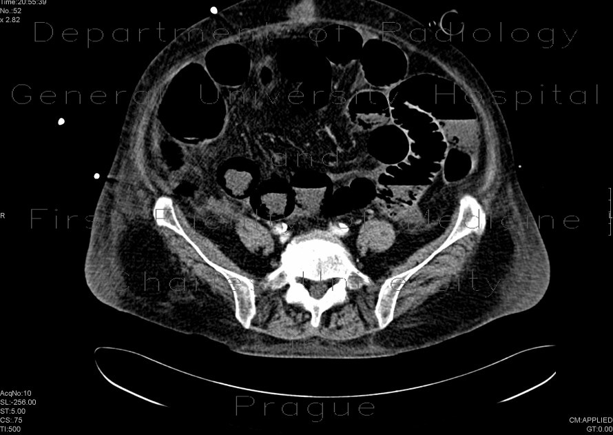 Bowel ischemia, gas in portal vein and liver
