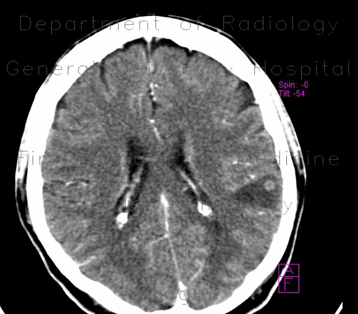 Brain metastasis