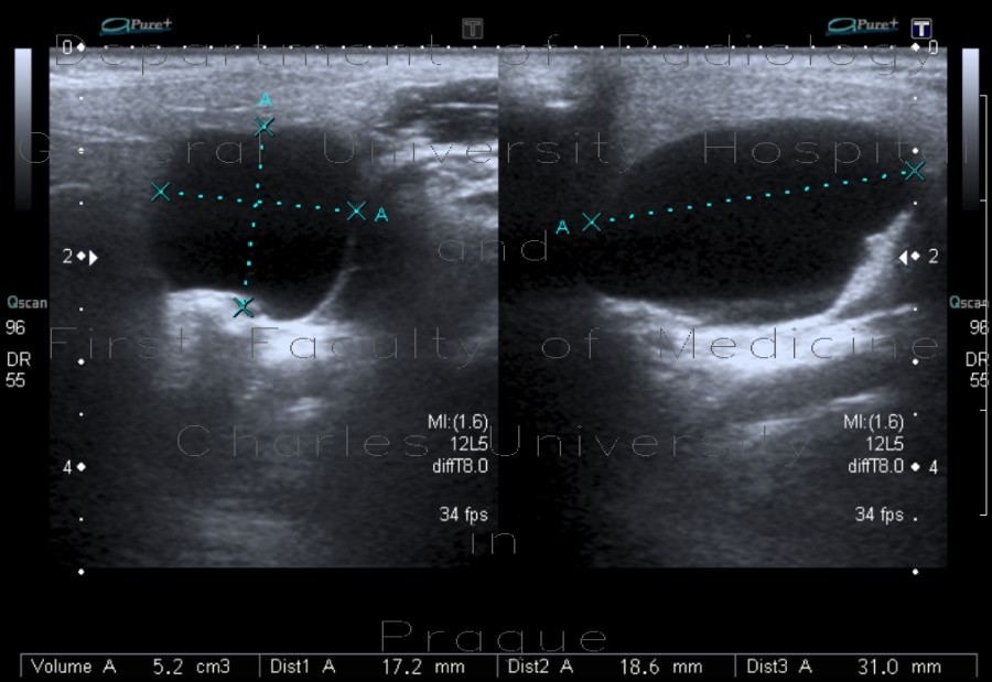 Branchial cleft cyst, parotid gland