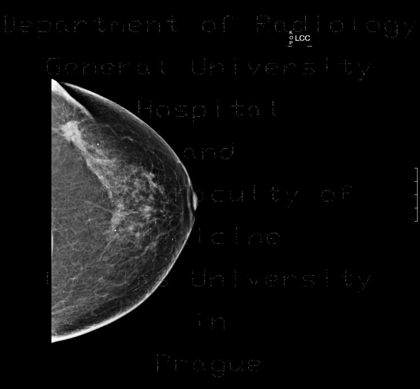 Breast carcinoma