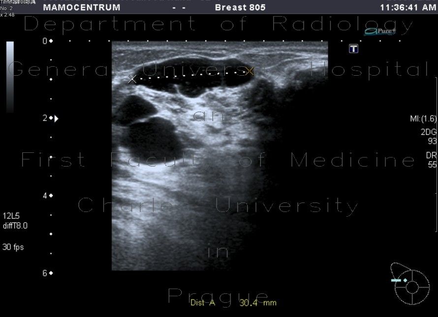 Breast cyst
