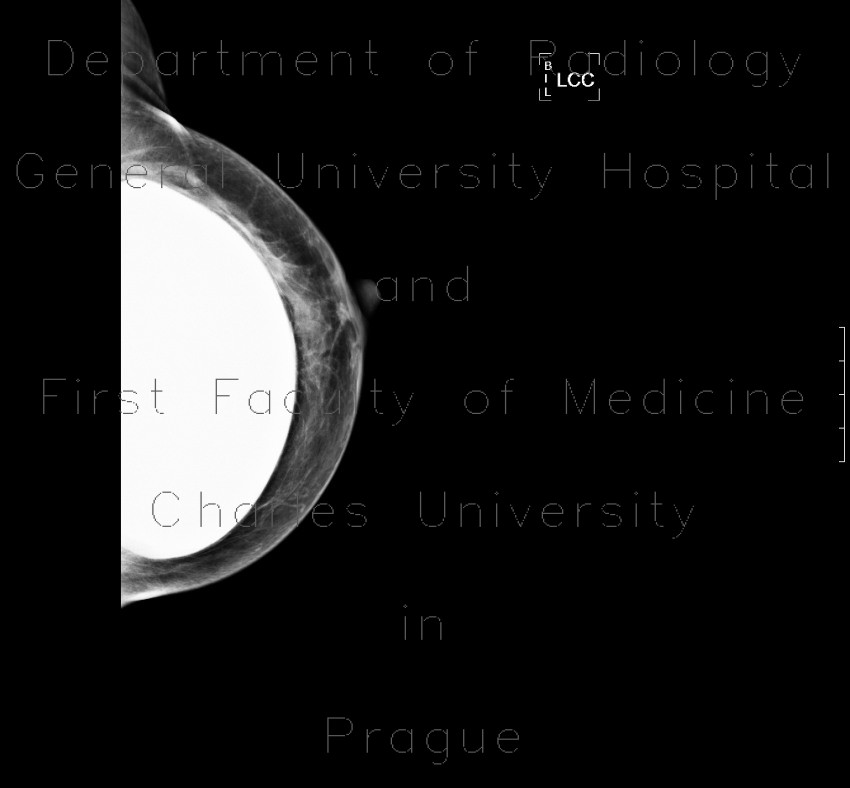 Breast implants, mammography