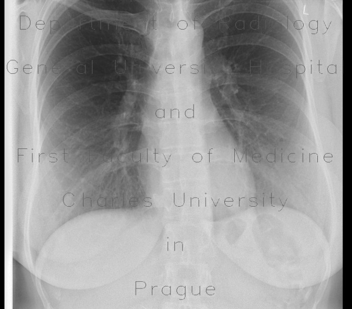 Breast implants on chest radiograph