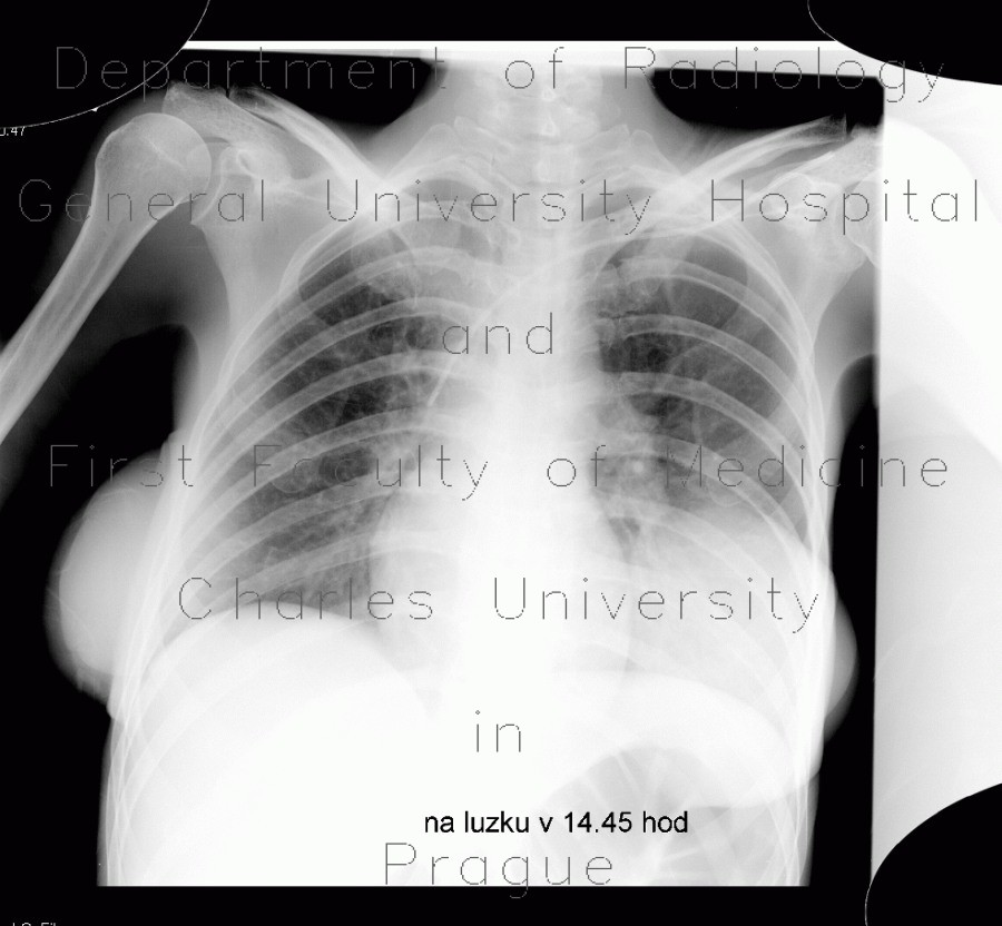 Breast implants on chest radiograph