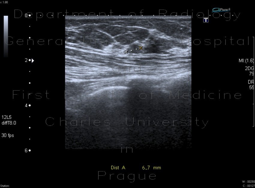 Breast tumour