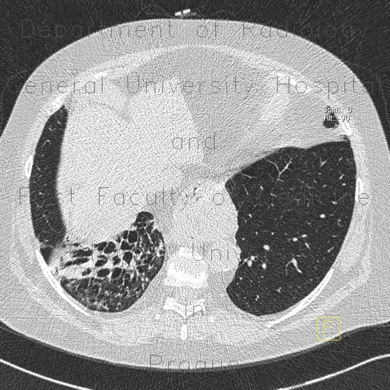 Bronchiectasia, HRCT